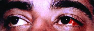 File:Dengue2.jpg