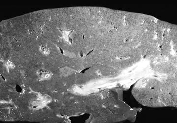 File:Hepatitis2.jpg