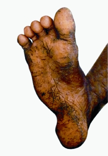 File:Arsenicosis2.jpg