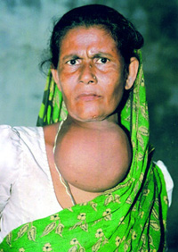 File:Goiter.jpg
