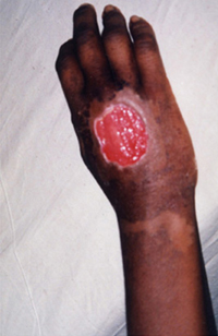 File:SnakeBite1.jpg