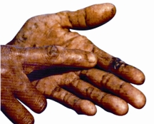 File:Arsenicosis1.jpg