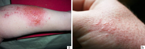 File:Itching.jpg